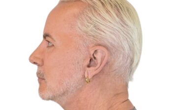 After facelift, left view of a male patient treated by Dr. Benjamin Eskenazi at Avabello Aesthetics in Miami Beach.