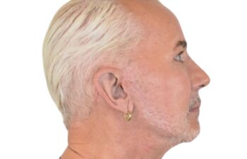 After facelift, right view of a male patient treated by Dr. Benjamin Eskenazi at Avabello Aesthetics in Miami Beach.