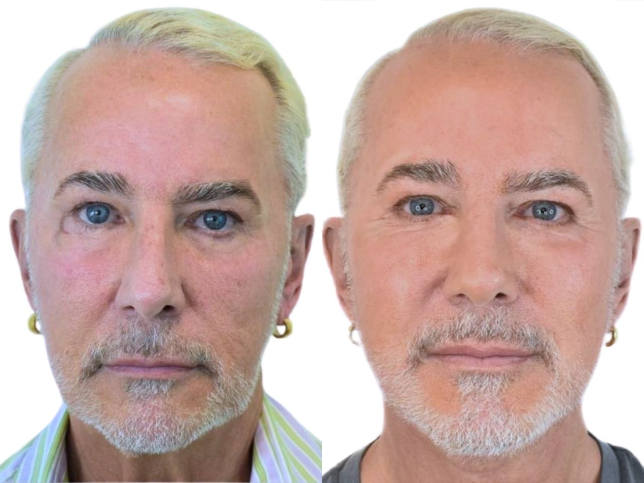 Before and after facelift, front view of a male patient treated by Dr. Benjamin Eskenazi at Avabello Aesthetics in Miami Beach.