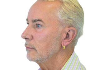 Before facelift, left oblique view of a male patient treated by Dr. Benjamin Eskenazi at Avabello Aesthetics in Miami Beach.