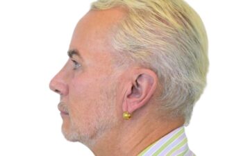 Before facelift, left view of a male patient treated by Dr. Benjamin Eskenazi at Avabello Aesthetics in Miami Beach.