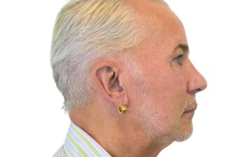 Before facelift, right view of a male patient treated by Dr. Benjamin Eskenazi at Avabello Aesthetics in Miami Beach.