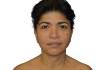 After facelift, front view of a female patient treated by Dr. Benjamin Eskenazi at Avabello Aesthetics in Miami Beach.
