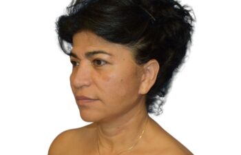 After facelift, left oblique view of a female patient treated by Dr. Benjamin Eskenazi at Avabello Aesthetics in Miami Beach.