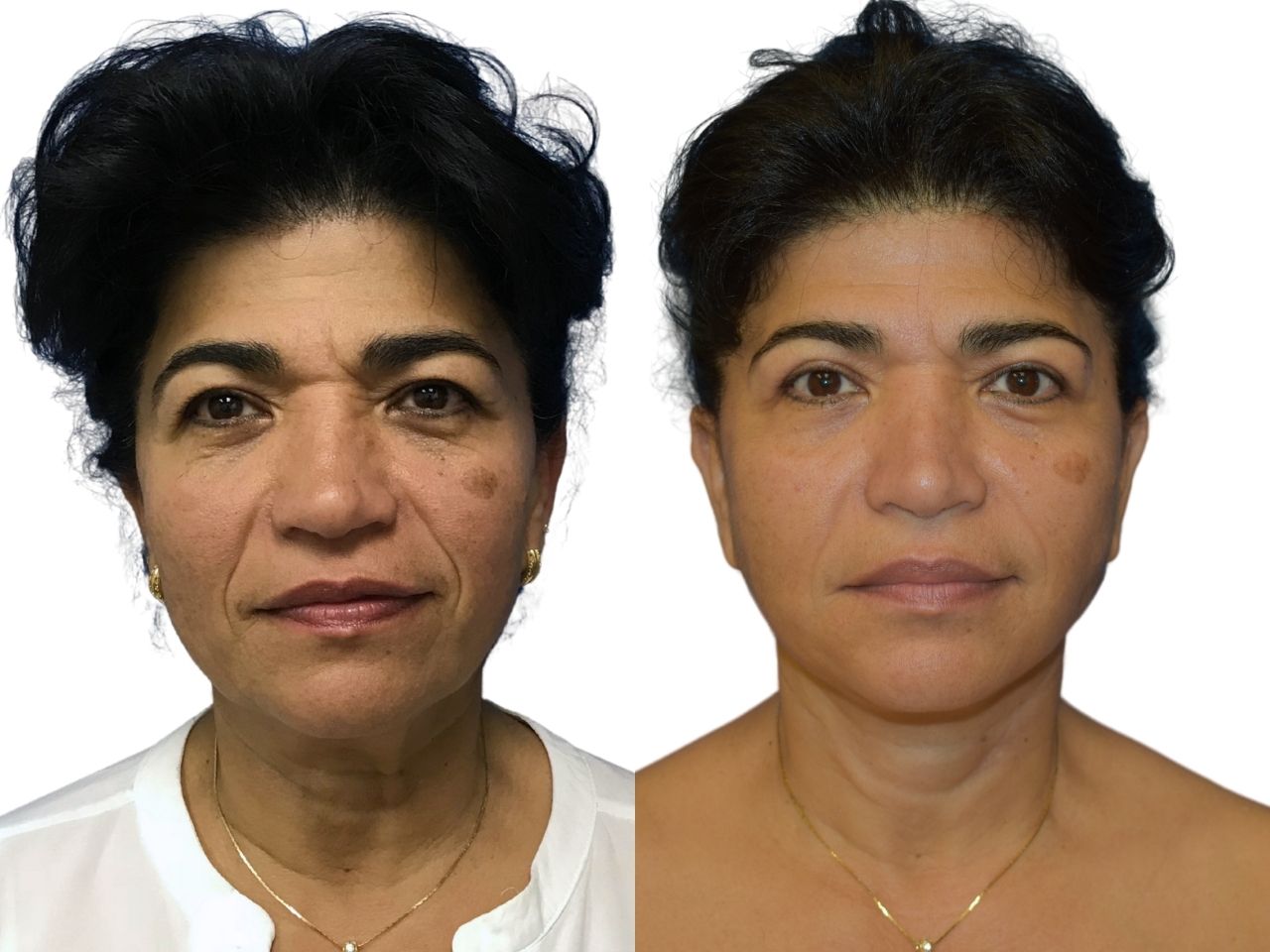 Before and after facelift, front view of a female patient treated by Dr. Benjamin Eskenazi at Avabello Aesthetics in Miami Beach.