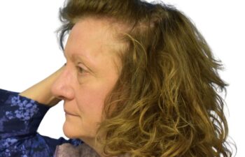 After fat grafting, left view of a female patient treated by Dr. Benjamin Eskenazi at Avabello Aesthetics in Miami Beach.