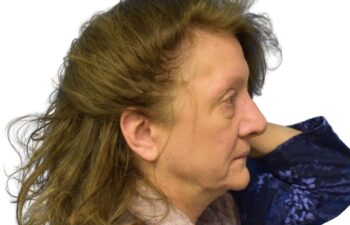 After fat grafting, right view of a female patient treated by Dr. Benjamin Eskenazi at Avabello Aesthetics in Miami Beach.