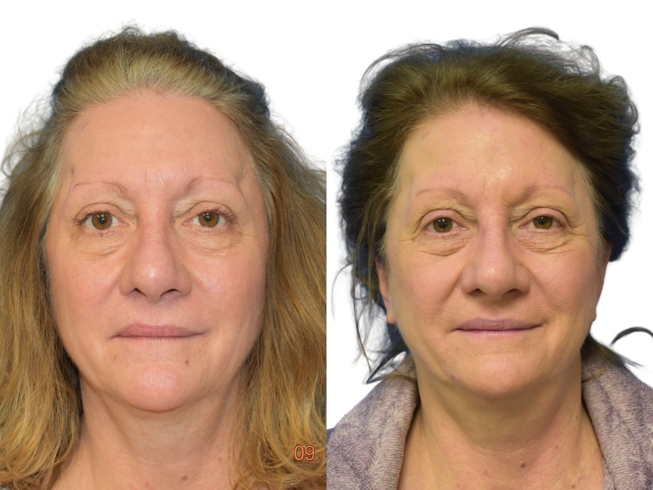 Before and after fat grafting, front view of a female patient treated by Dr. Benjamin Eskenazi at Avabello Aesthetics in Miami Beach.