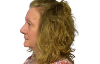 After fat grafting, left view of a female patient treated by Dr. Benjamin Eskenazi at Avabello Aesthetics in Miami Beach.