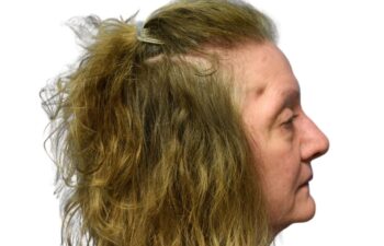 After fat grafting, right view of a female patient treated by Dr. Benjamin Eskenazi at Avabello Aesthetics in Miami Beach.