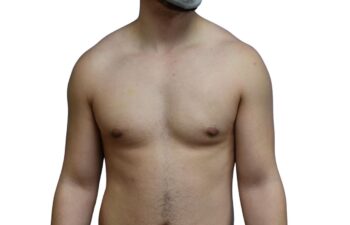 After gynecomastia surgery, front view of a male patient treated by Dr. Benjamin Eskenazi at Avabello Aesthetics in Miami Beach.