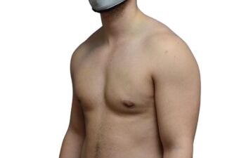 After gynecomastia surgery, left oblique view of a male patient treated by Dr. Benjamin Eskenazi at Avabello Aesthetics in Miami Beach.