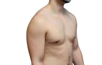 After gynecomastia surgery, right oblique view of a male patient treated by Dr. Benjamin Eskenazi at Avabello Aesthetics in Miami Beach.