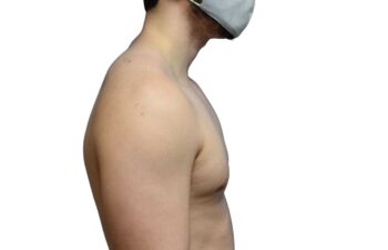 After gynecomastia surgery, right view of a male patient treated by Dr. Benjamin Eskenazi at Avabello Aesthetics in Miami Beach.