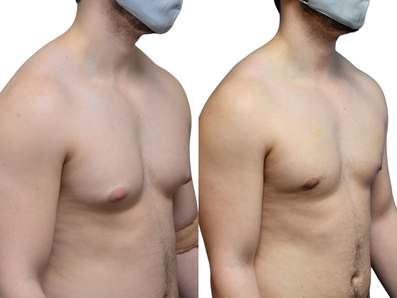 Before and after gynecomastia surgery, right oblique view of a male patient treated by Dr. Benjamin Eskenazi at Avabello Aesthetics in Miami Beach.
