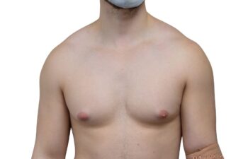 Before gynecomastia surgery, front view of a male patient treated by Dr. Benjamin Eskenazi at Avabello Aesthetics in Miami Beach.