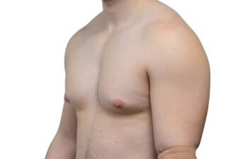 Before gynecomastia surgery, left oblique view of a male patient treated by Dr. Benjamin Eskenazi at Avabello Aesthetics in Miami Beach.