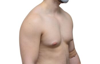 Before gynecomastia surgery, right oblique view of a male patient treated by Dr. Benjamin Eskenazi at Avabello Aesthetics in Miami Beach.