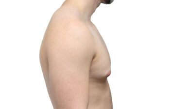 Before gynecomastia surgery, right view of a male patient treated by Dr. Benjamin Eskenazi at Avabello Aesthetics in Miami Beach.