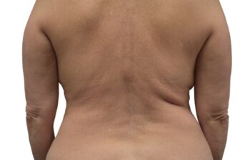 After Lipo 360, back view of a female patient treated by Dr. Benjamin Eskenazi at Avabello Aesthetics in Miami Beach.
