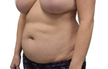 After Lipo 360, left oblique view of a female patient treated by Dr. Benjamin Eskenazi at Avabello Aesthetics in Miami Beach.