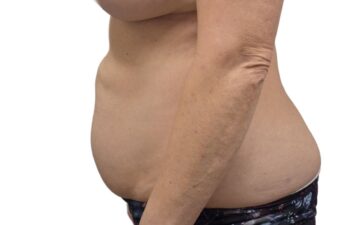 After Lipo 360, left view of a female patient treated by Dr. Benjamin Eskenazi at Avabello Aesthetics in Miami Beach.