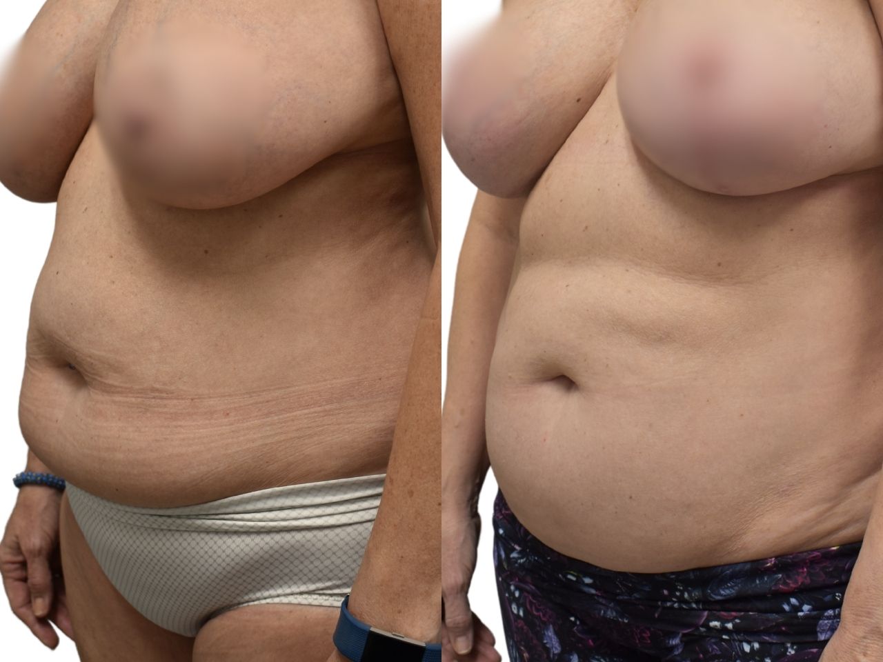 Before and after Lipo 360, left oblique view of a female patient treated by Dr. Benjamin Eskenazi at Avabello Aesthetics in Miami Beach.