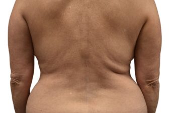 Before Lipo 360, back view of a female patient treated by Dr. Benjamin Eskenazi at Avabello Aesthetics in Miami Beach.