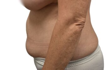 Before Lipo 360, left view of a female patient treated by Dr. Benjamin Eskenazi at Avabello Aesthetics in Miami Beach.