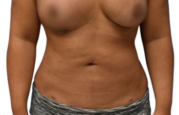 After liposuction of the abdomen, front view of a female patient treated by Dr. Benjamin Eskenazi at Avabello Aesthetics.