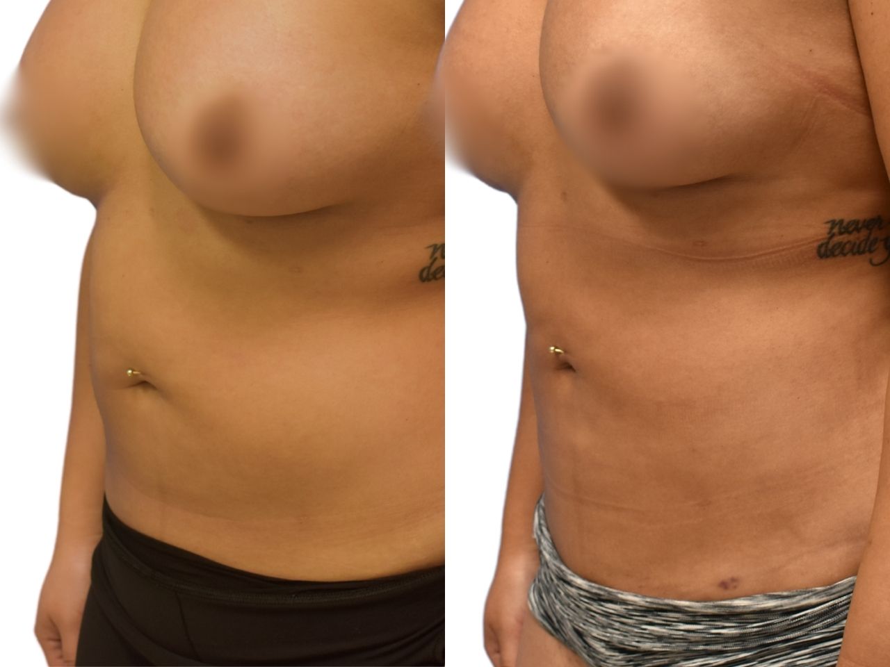Before and after liposuction of the abdomen, left oblique view of a female patient treated by Dr. Benjamin Eskenazi at Avabello Aesthetics.