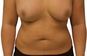 Before liposuction of the abdomen, front view of a female patient treated by Dr. Benjamin Eskenazi at Avabello Aesthetics.
