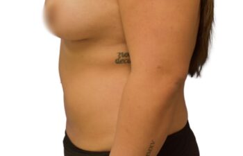 Before liposuction of the abdomen, left view of a female patient treated by Dr. Benjamin Eskenazi at Avabello Aesthetics.