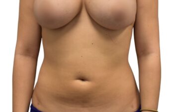 After liposuction of the abdomen, front view of a female patient treated by Dr. Benjamin Eskenazi at Avabello Aesthetics.