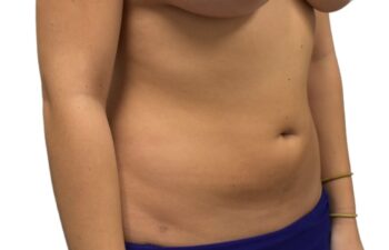 After liposuction of the abdomen, right oblique view of a female patient treated by Dr. Benjamin Eskenazi at Avabello Aesthetics.
