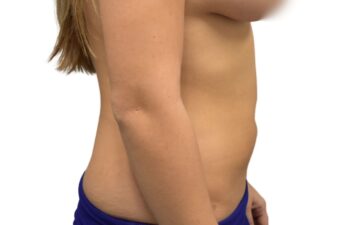 After liposuction of the abdomen, right view of a female patient treated by Dr. Benjamin Eskenazi at Avabello Aesthetics.