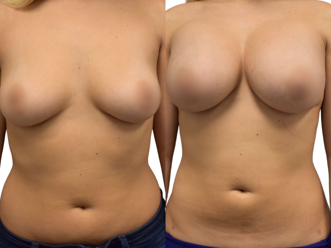 Before and after liposuction of the abdomen, front view of a female patient treated by Dr. Benjamin Eskenazi at Avabello Aesthetics.
