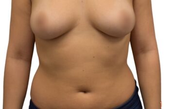 Before liposuction of the abdomen, front view of a female patient treated by Dr. Benjamin Eskenazi at Avabello Aesthetics.