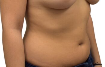 After liposuction of the abdomen, right oblique view of a female patient treated by Dr. Benjamin Eskenazi at Avabello Aesthetics.