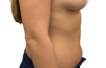 After liposuction of the abdomen, right view of a female patient treated by Dr. Benjamin Eskenazi at Avabello Aesthetics.