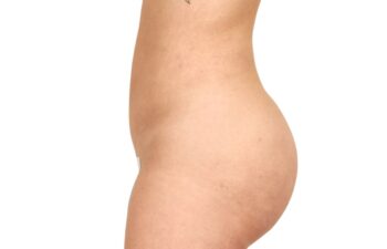 After liposuction of the abdomen and flanks, left view of a female patient treated by Dr. Benjamin Eskenazi at Avabello Aesthetics