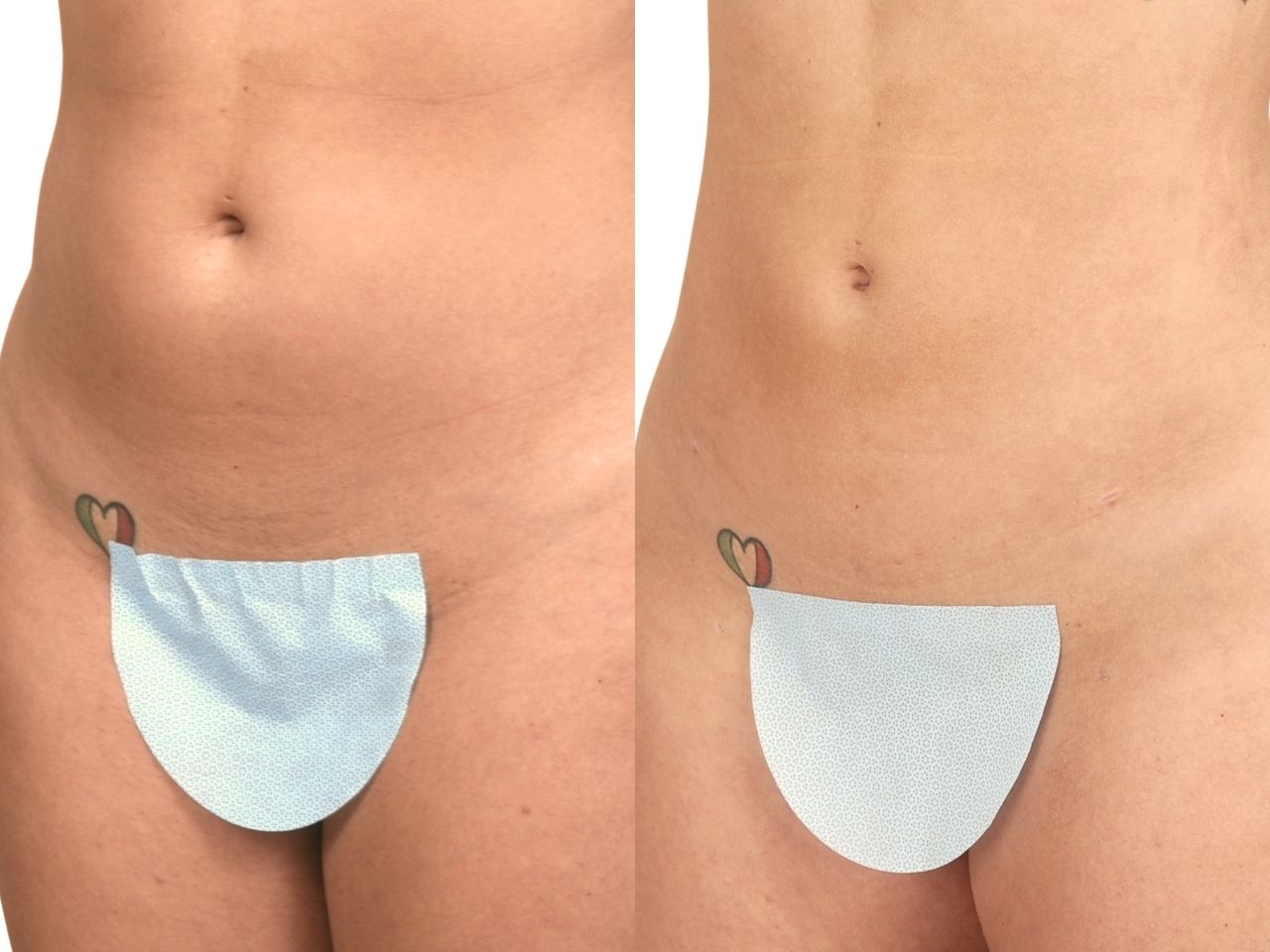 Before and after liposuction of the abdomen and flanks, left oblique view of a female patient treated by Dr. Benjamin Eskenazi at Avabello Aesthetics