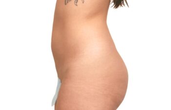 Before liposuction of the abdomen and flanks, left view of a female patient treated by Dr. Benjamin Eskenazi at Avabello Aesthetics