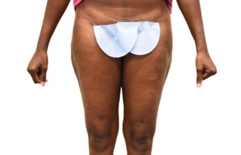 After liposuction of the saddle bags (outer thighs), front view of a female patient treated by Dr. Benjamin Eskenazi at Avabello Aesthetics.