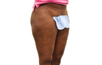 After liposuction of the saddle bags (outer thighs), right oblique view of a female patient treated by Dr. Benjamin Eskenazi at Avabello Aesthetics.