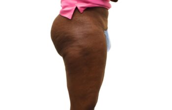 After liposuction of the saddle bags (outer thighs), right view of a female patient treated by Dr. Benjamin Eskenazi at Avabello Aesthetics.