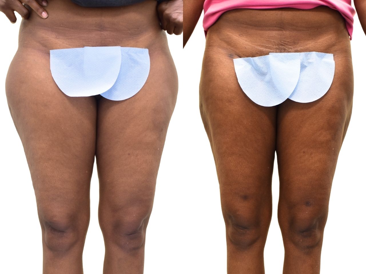 Before and after liposuction of the saddle bags (outer thighs), front view of a female patient treated by Dr. Benjamin Eskenazi at Avabello Aesthetics.