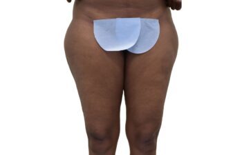 Before liposuction of the saddle bags (outer thighs), front view of a female patient treated by Dr. Benjamin Eskenazi at Avabello Aesthetics.