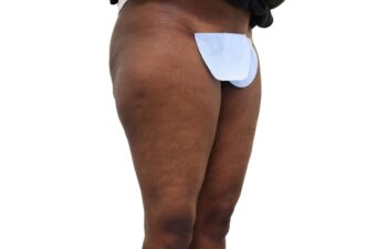 Before liposuction of the saddle bags (outer thighs), right oblique view of a female patient treated by Dr. Benjamin Eskenazi at Avabello Aesthetics.