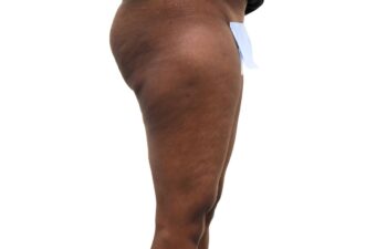 Before liposuction of the saddle bags (outer thighs), right view of a female patient treated by Dr. Benjamin Eskenazi at Avabello Aesthetics.